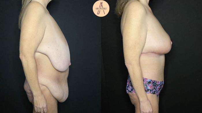 Before & After Tummy Tuck Case 182 Right Side View in San Antonio, Texas