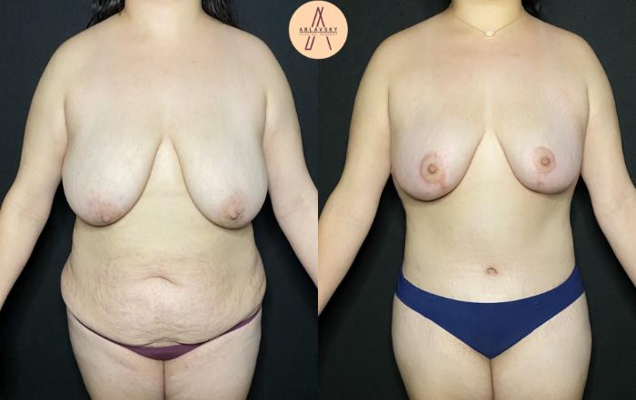 Before & After Tummy Tuck Case 193 Front View in San Antonio, Texas
