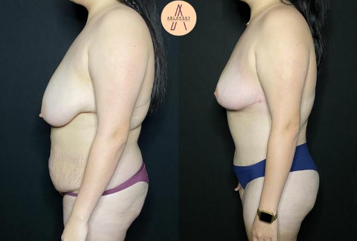 Before & After Tummy Tuck Case 193 Left Side View in San Antonio, Texas