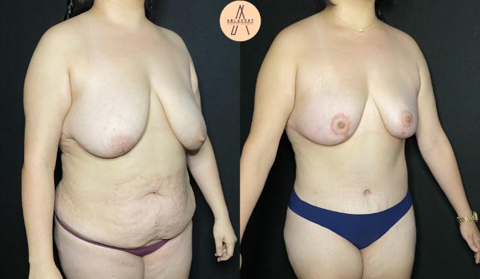 Before & After Tummy Tuck Case 193 Right Oblique View in San Antonio, Texas
