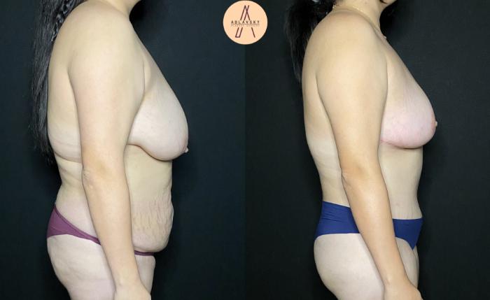 Before & After Breast Reduction Case 193 Right Side View in San Antonio, Texas