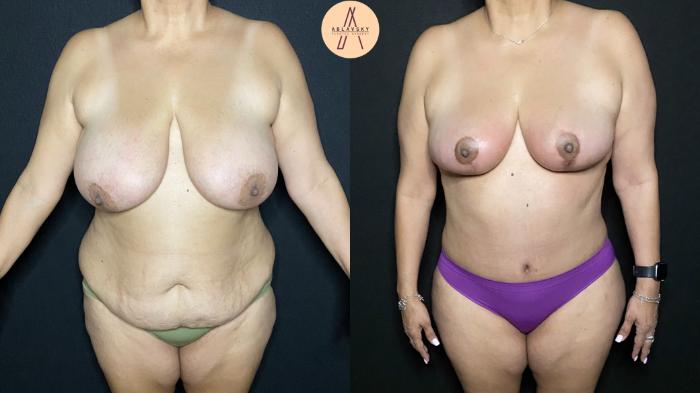 Before & After Breast Reduction Case 199 Front View in San Antonio, Texas
