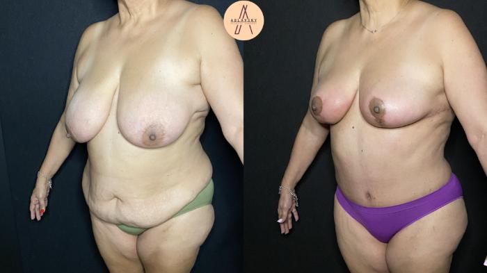 Before & After Mommy Makeover Case 199 Left Oblique View in San Antonio, Texas