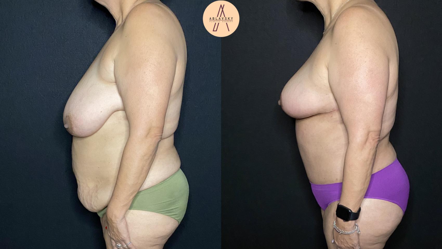 Before & After Mommy Makeover Case 199 Left Side View in San Antonio, Texas