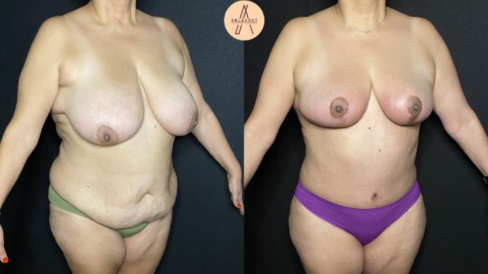 Before & After Breast Reduction Case 199 Right Oblique View in San Antonio, Texas