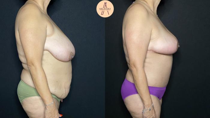 Before & After Breast Reduction Case 199 Right Side View in San Antonio, Texas