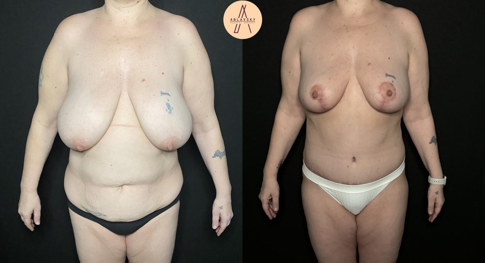 Before & After Liposuction Case 225 Front View in San Antonio, Texas