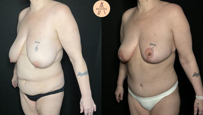 Before & After Liposuction Case 225 Left Oblique View in San Antonio, Texas