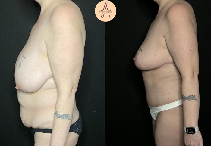 Before & After Breast Reduction Case 225 Left Side View in San Antonio, Texas