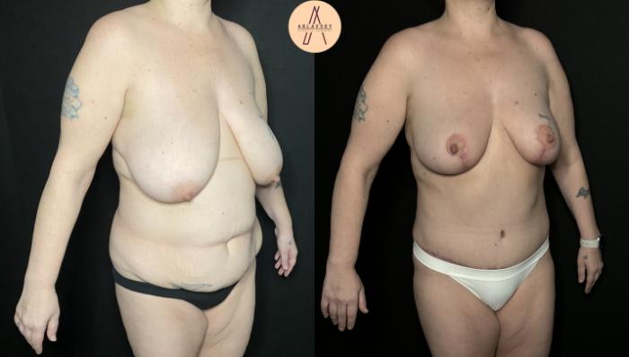 Before & After Liposuction Case 225 Right Oblique View in San Antonio, Texas