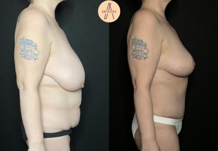 Before & After Breast Lift Case 225 Right Side View in San Antonio, Texas