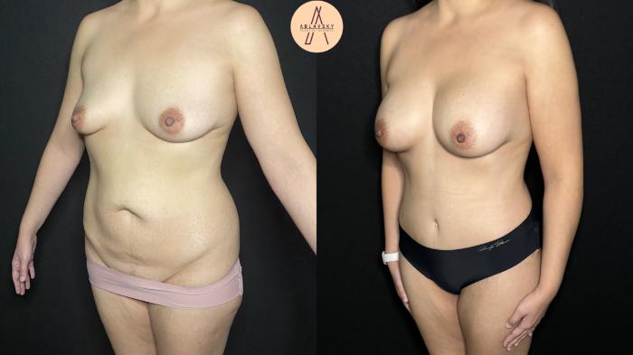 Before & After Mommy Makeover Case 227 Left Oblique View in San Antonio, Texas