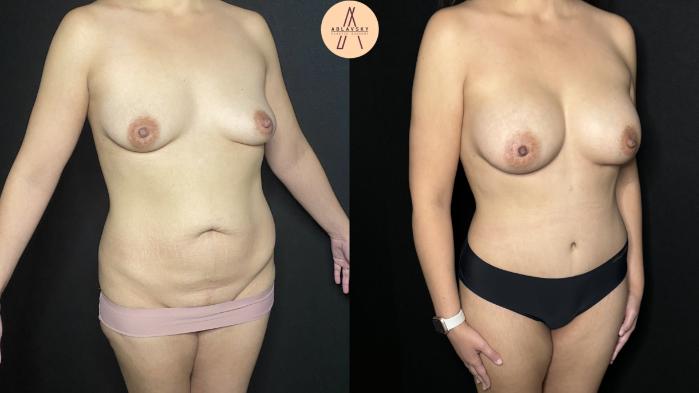 Before & After Mommy Makeover Case 227 Right Oblique View in San Antonio, Texas