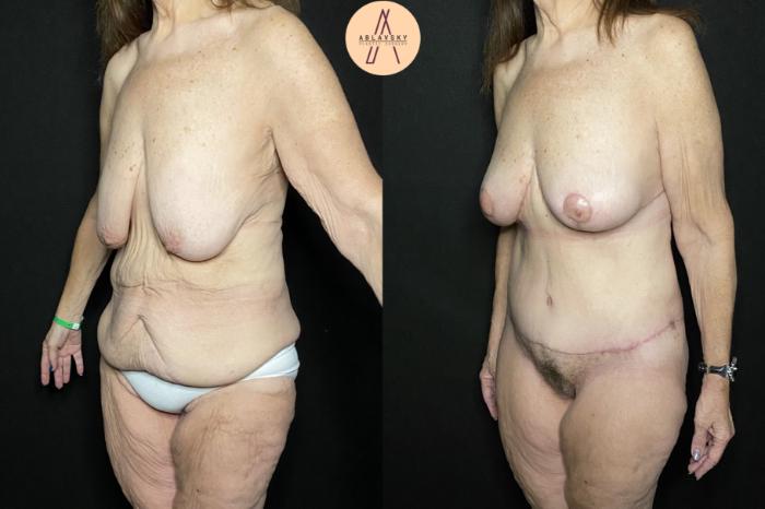 Before & After Mommy Makeover Case 233 Left Oblique View in San Antonio, Texas