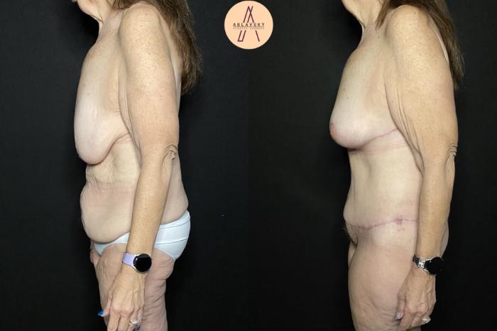 Before & After Mommy Makeover Case 233 Left Side View in San Antonio, Texas