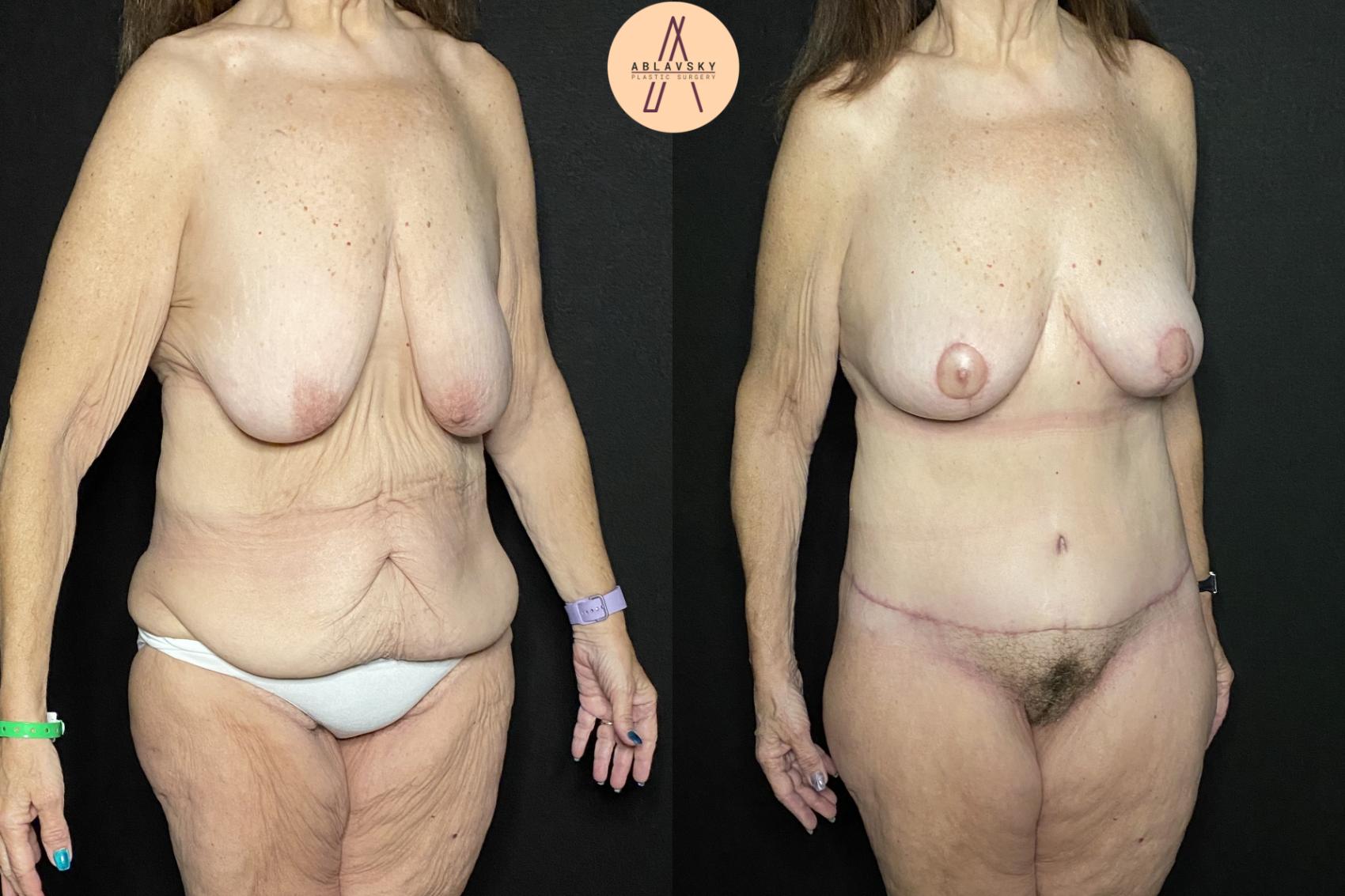 Before & After Breast Lift Case 233 Right Oblique View in San Antonio, Texas