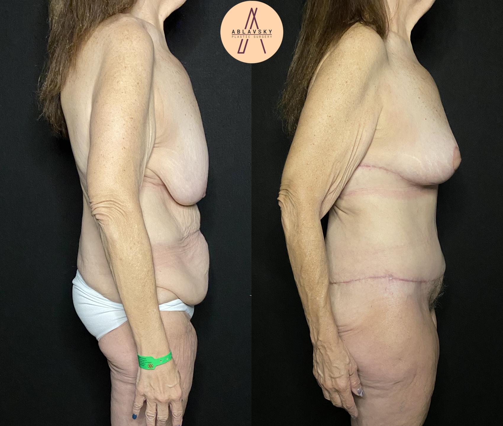 Before & After Breast Lift Case 233 Right Side View in San Antonio, Texas