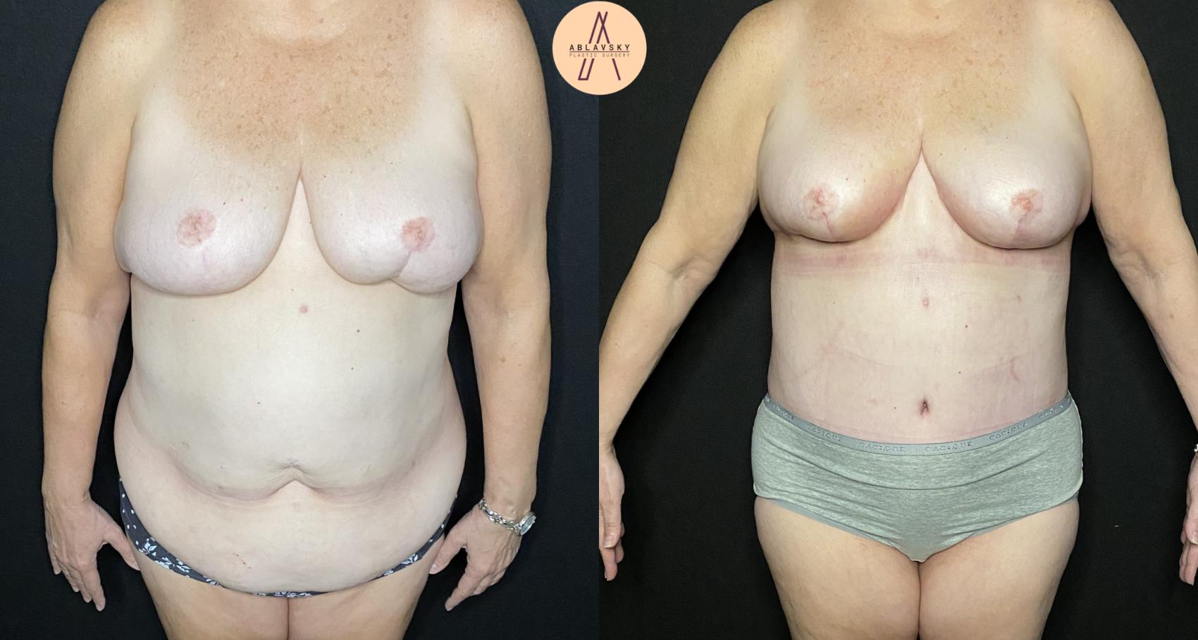 Before & After Breast Lift Case 234 Front View in San Antonio, Texas