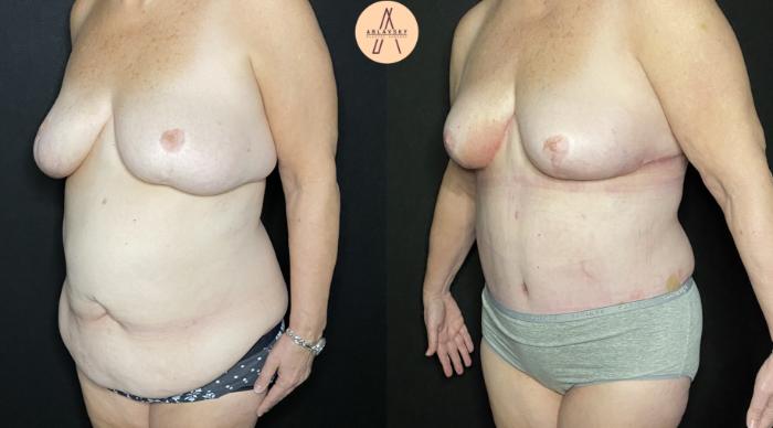 Before & After Breast Lift Case 234 Left Oblique View in San Antonio, Texas