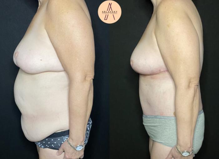 Before & After Breast Lift Case 234 Left Side View in San Antonio, Texas