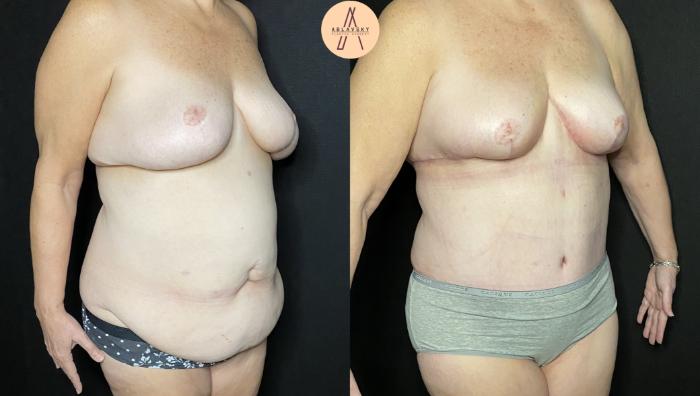 Before & After Mommy Makeover Case 234 Right Oblique View in San Antonio, Texas