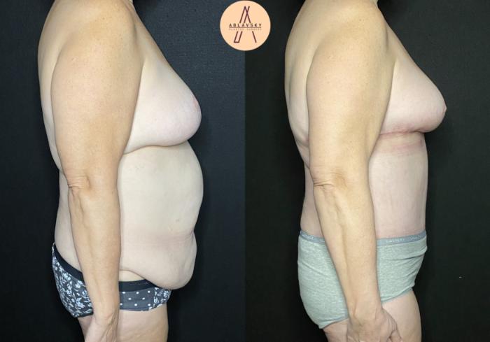 Before & After Breast Lift Case 234 Right Side View in San Antonio, Texas