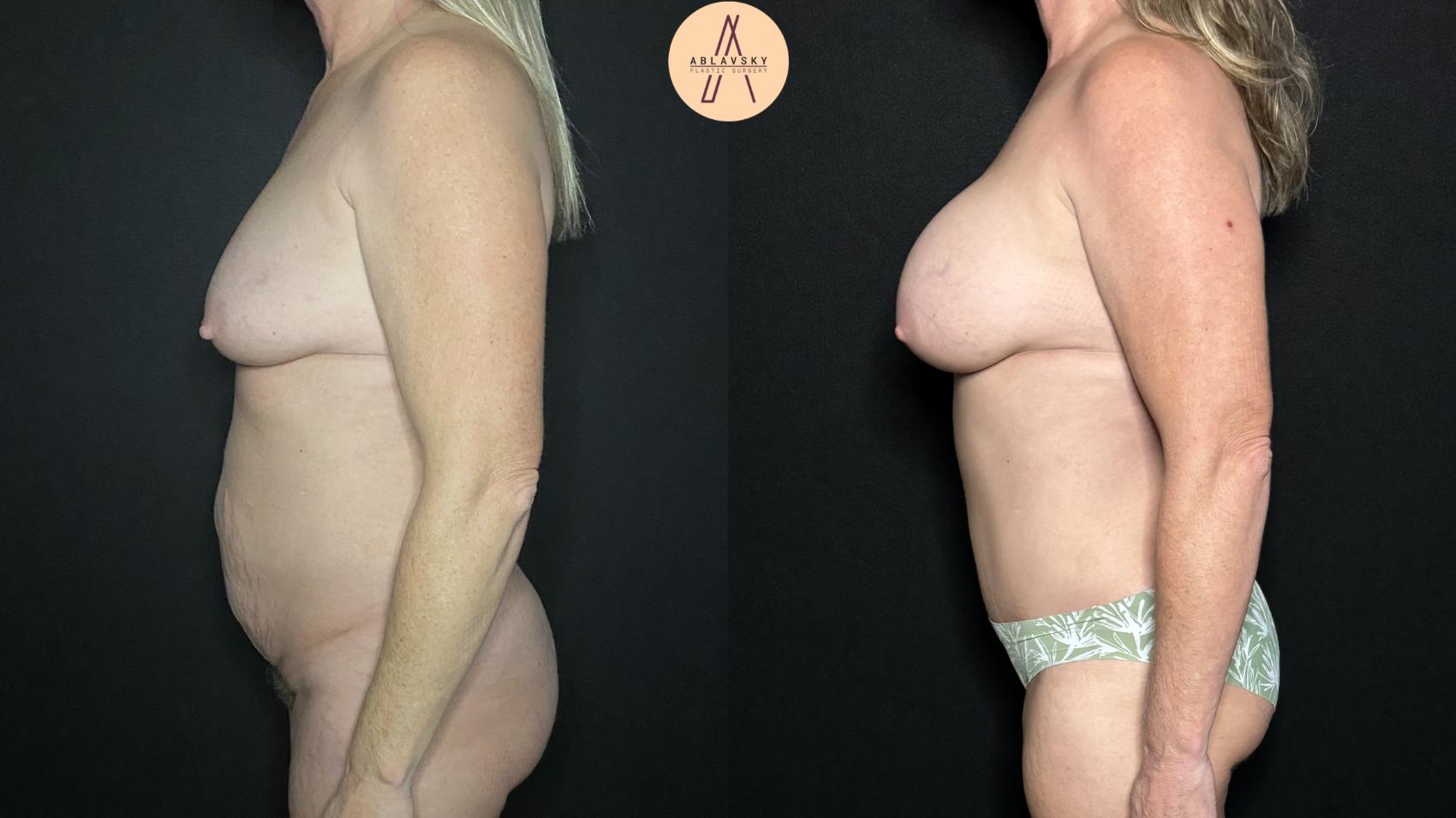 Before & After Tummy Tuck Case 242 Left Side View in San Antonio, Texas