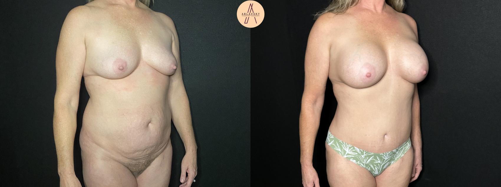 Before & After Tummy Tuck Case 242 Right Oblique View in San Antonio, Texas