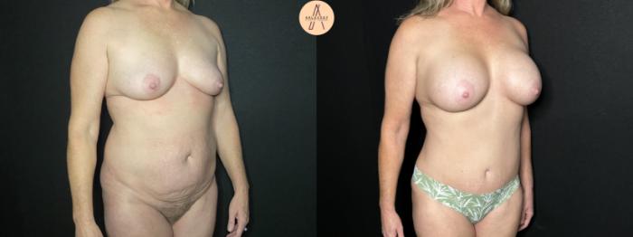 Before & After Mommy Makeover Case 242 Right Oblique View in San Antonio, Texas