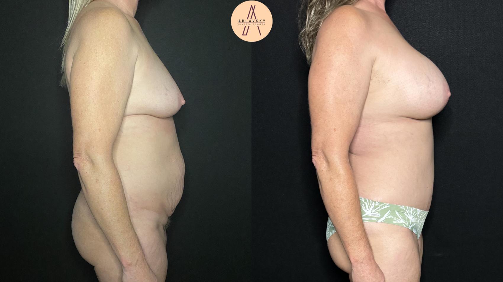Before & After Tummy Tuck Case 242 Right Side View in San Antonio, Texas