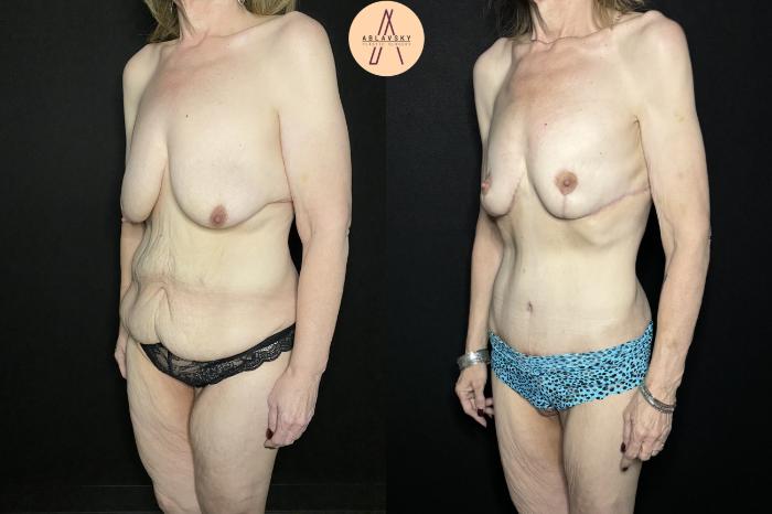 Before & After Mommy Makeover Case 250 Left Oblique View in San Antonio, Texas