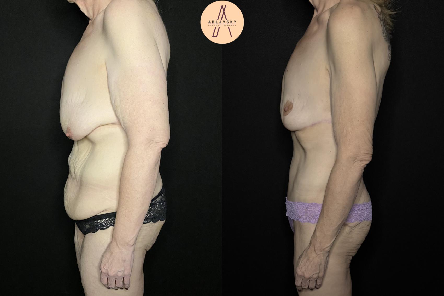Before & After Mommy Makeover Case 250 Left Side View in San Antonio, Texas