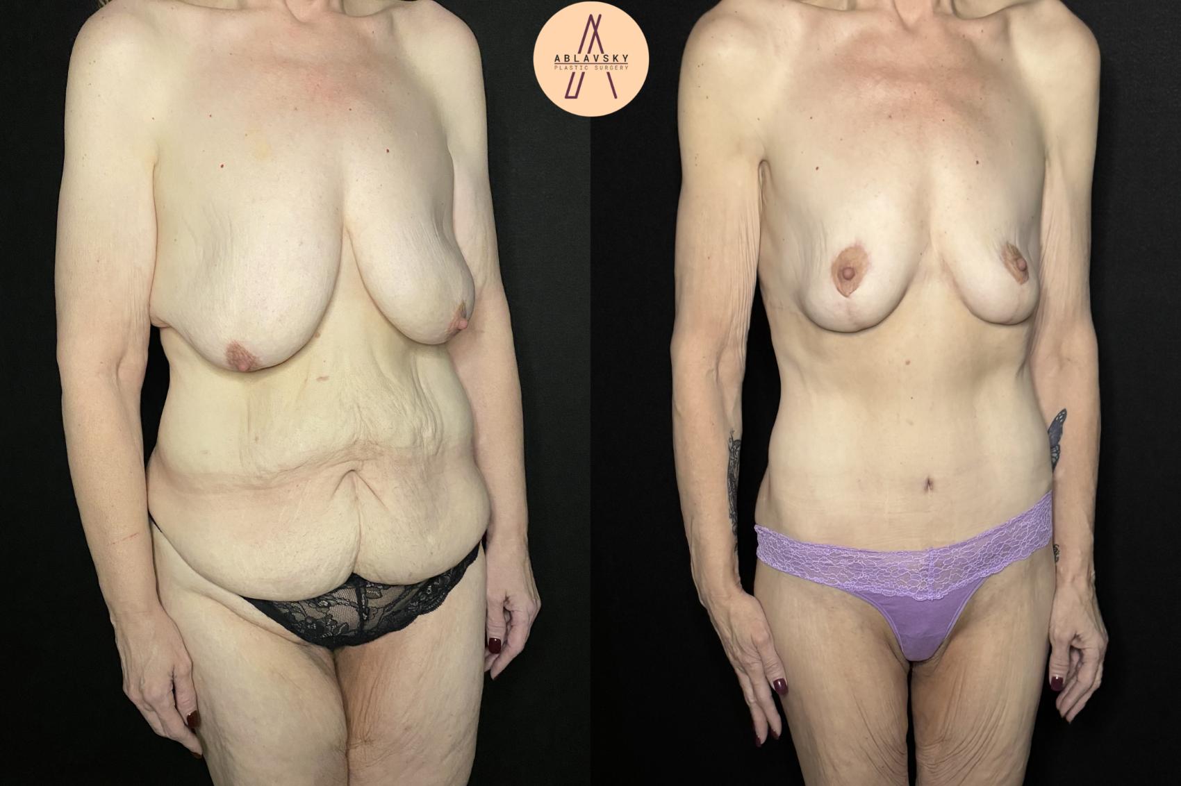 Before & After Mommy Makeover Case 250 Right Oblique View in San Antonio, Texas