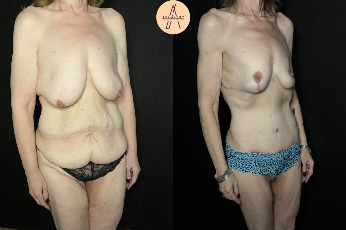 Before & After Mommy Makeover Case 250 Right Oblique View in San Antonio, Texas