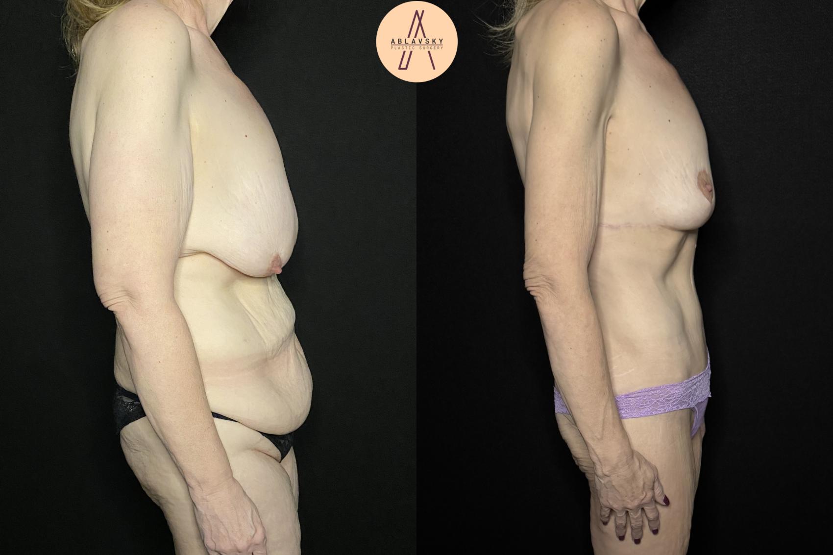 Before & After Mommy Makeover Case 250 Right Side View in San Antonio, Texas