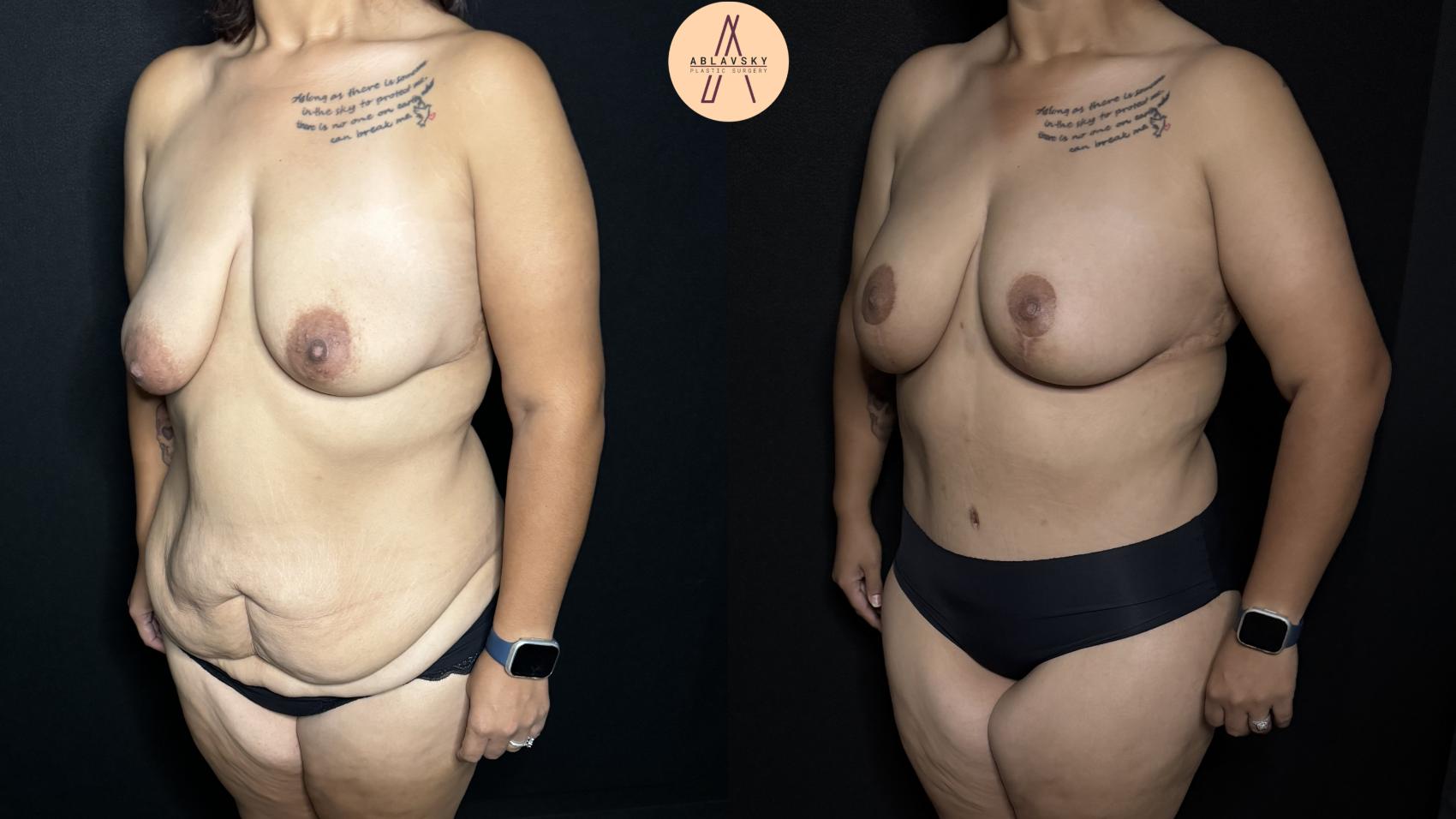 Before & After Tummy Tuck Case 284 Left Oblique View in San Antonio, Texas