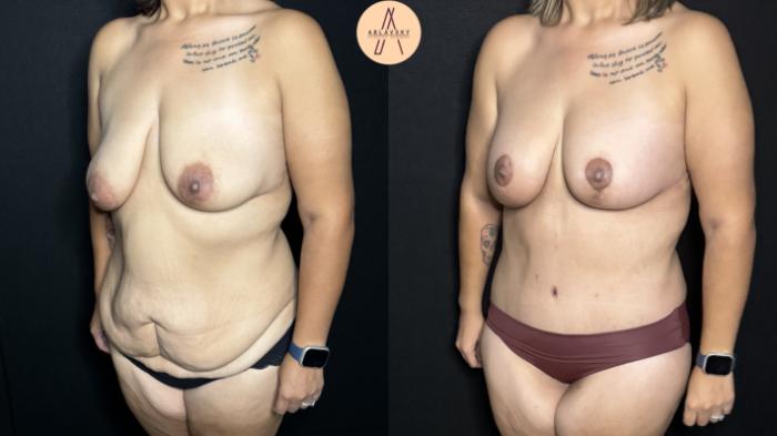 Before & After Mommy Makeover Case 284 Left Oblique View in San Antonio, Texas