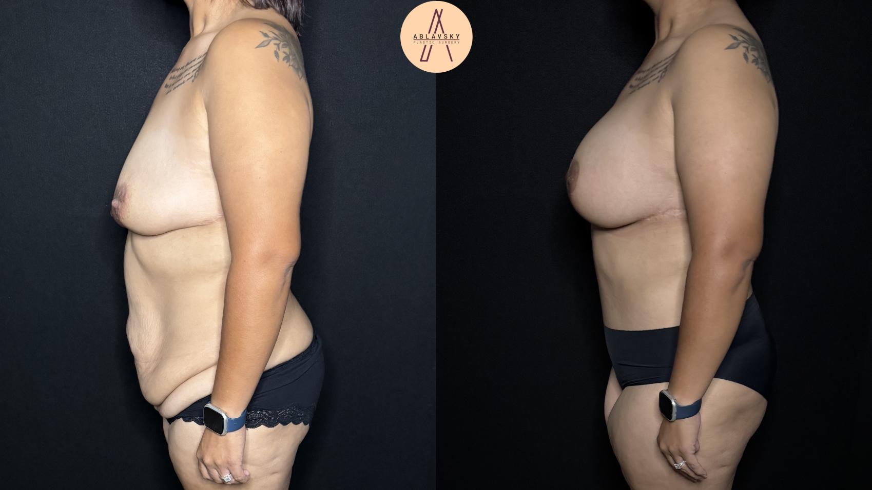 Before & After Tummy Tuck Case 284 Left Side View in San Antonio, Texas