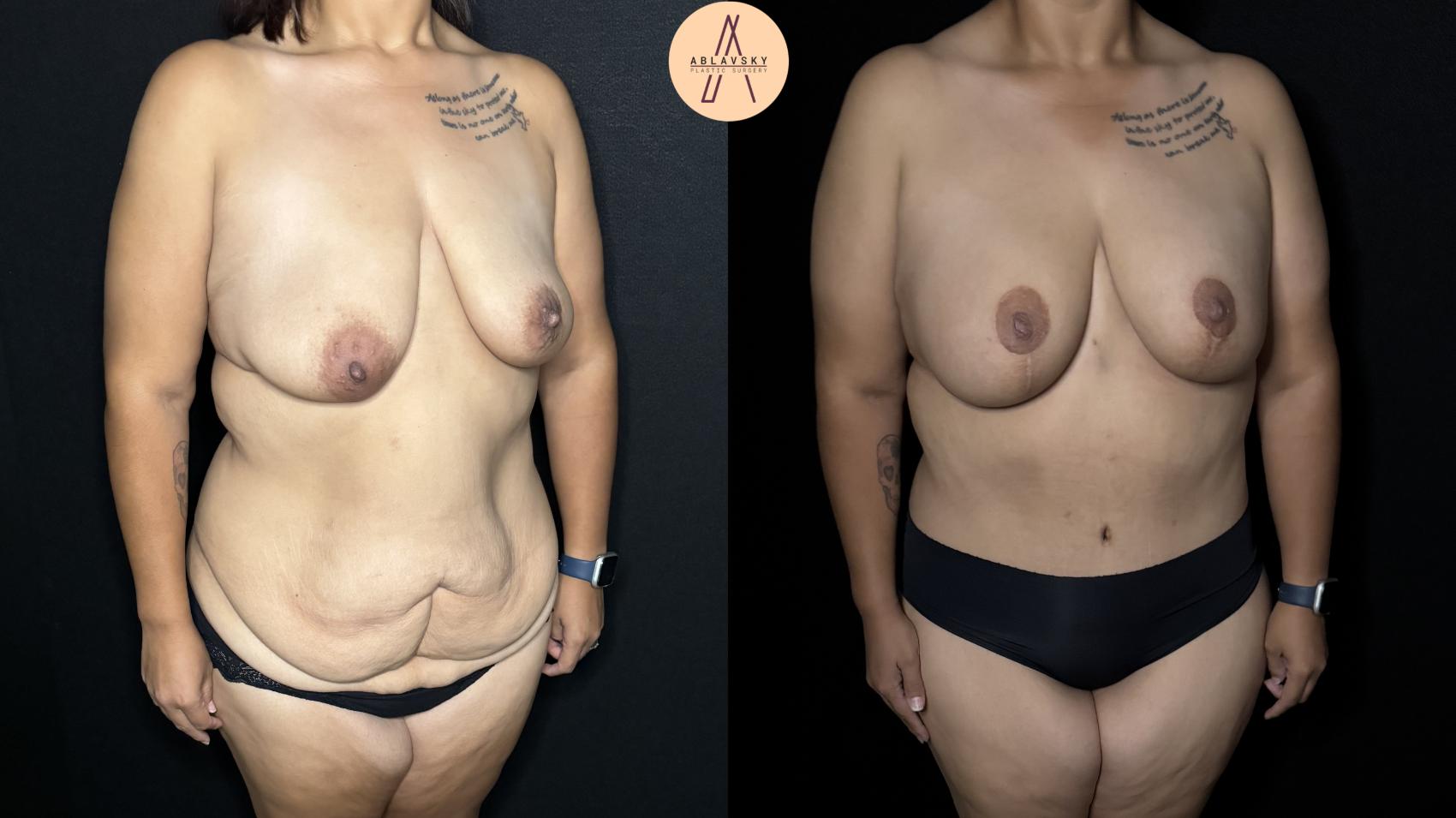 Before & After Tummy Tuck Case 284 Right Oblique View in San Antonio, Texas
