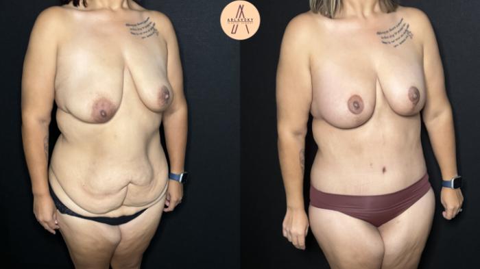 Before & After Mommy Makeover Case 284 Right Oblique View in San Antonio, Texas