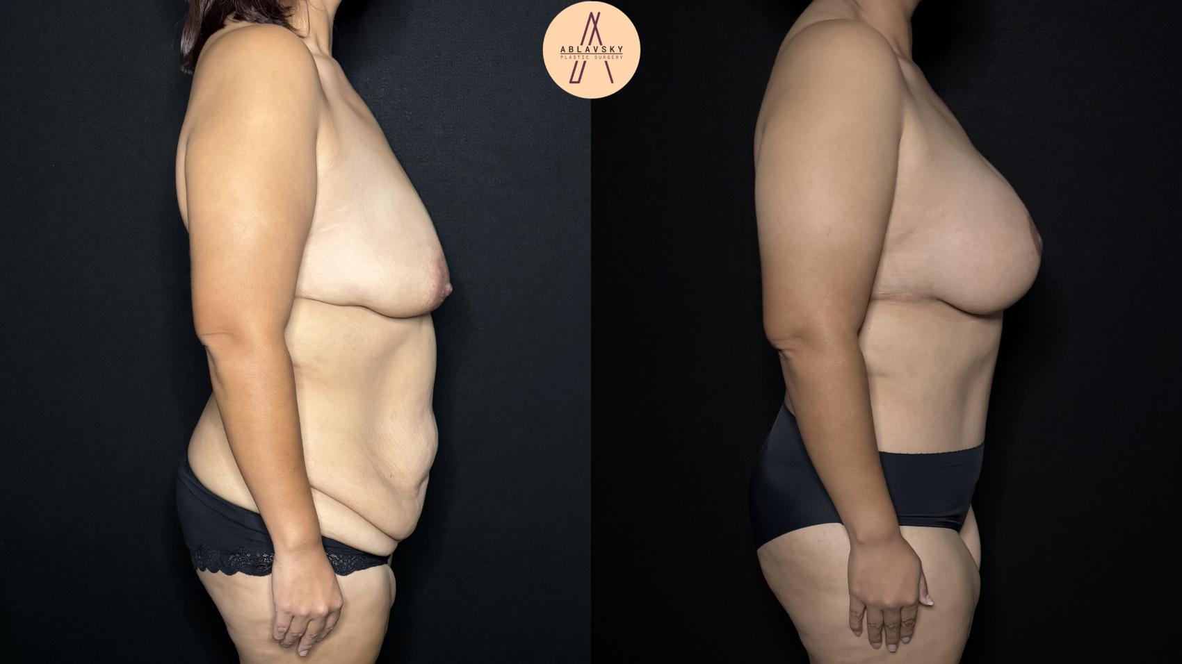 Before & After Tummy Tuck Case 284 Right Side View in San Antonio, Texas