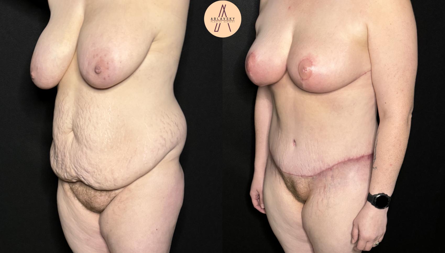 Before & After Breast Lift Case 287 Left Oblique View in San Antonio, Texas