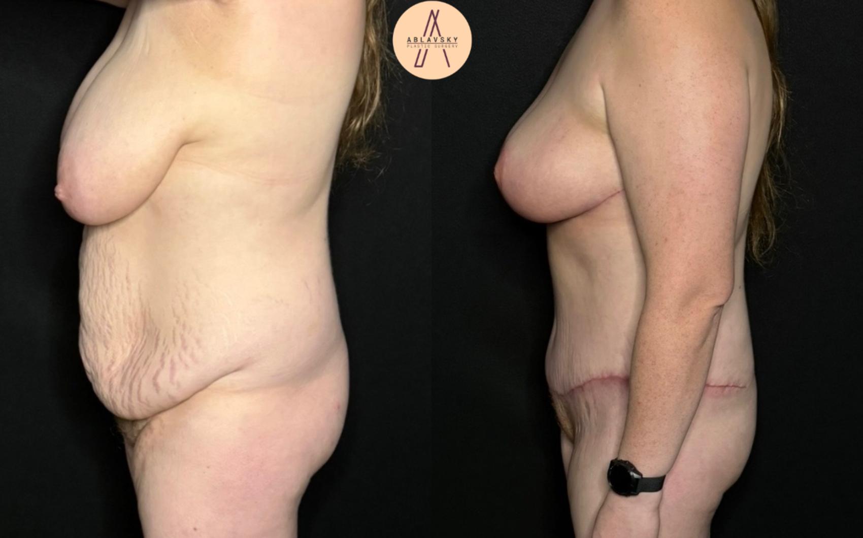Before & After Breast Lift Case 287 Left Side View in San Antonio, Texas