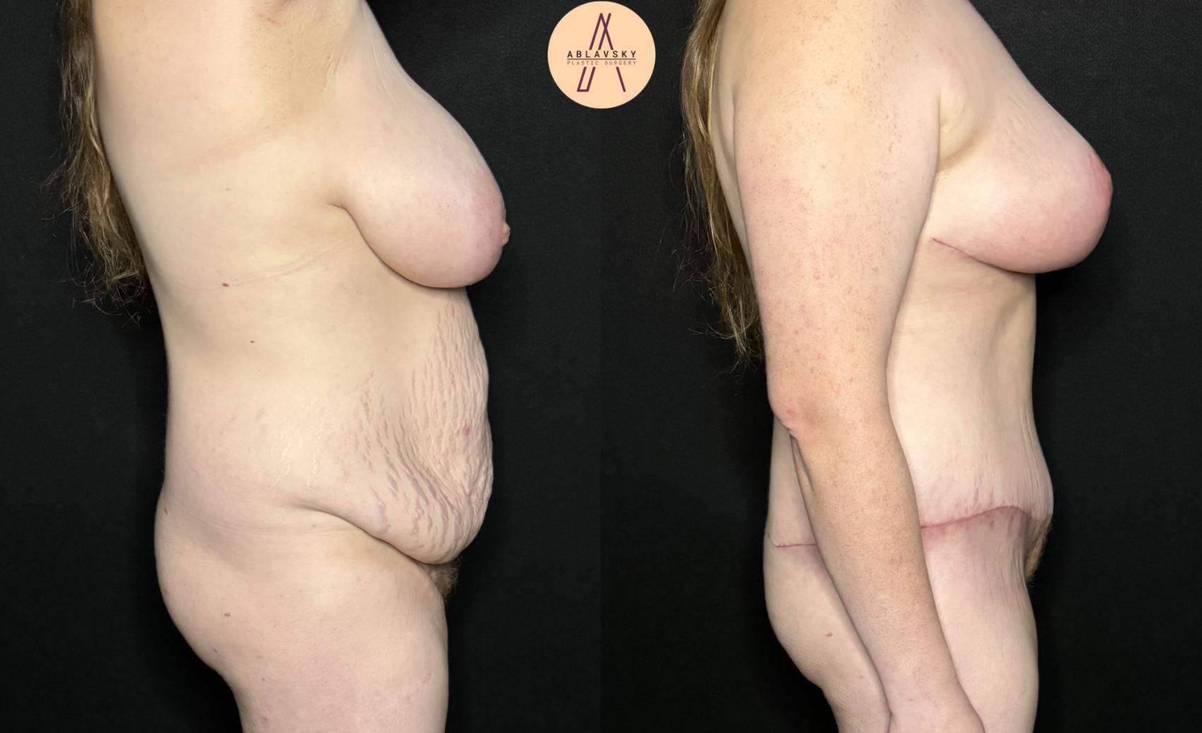 Before & After Breast Lift Case 287 Right Side View in San Antonio, Texas