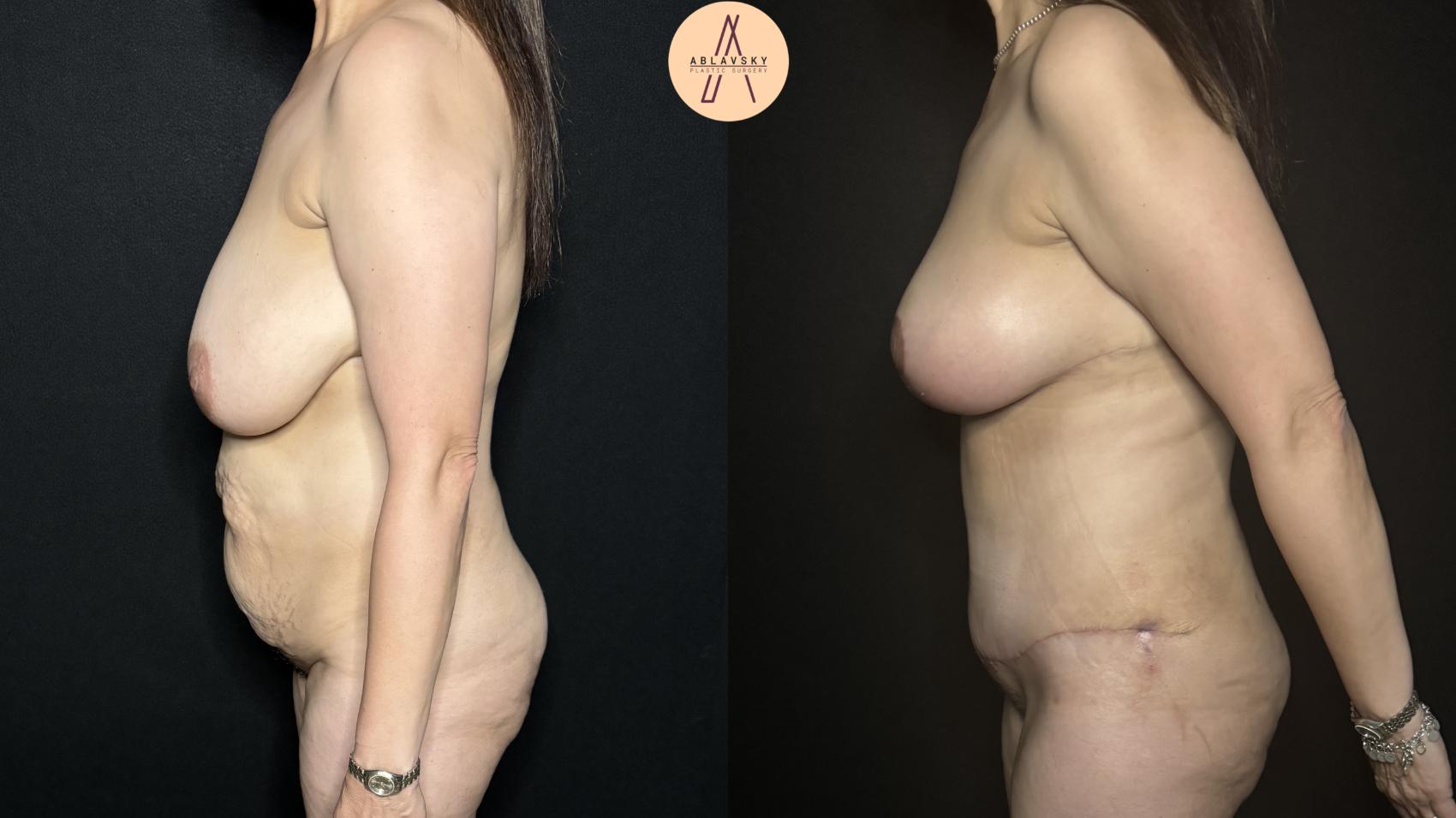 Before & After Tummy Tuck Case 288 Left Side View in San Antonio, Texas
