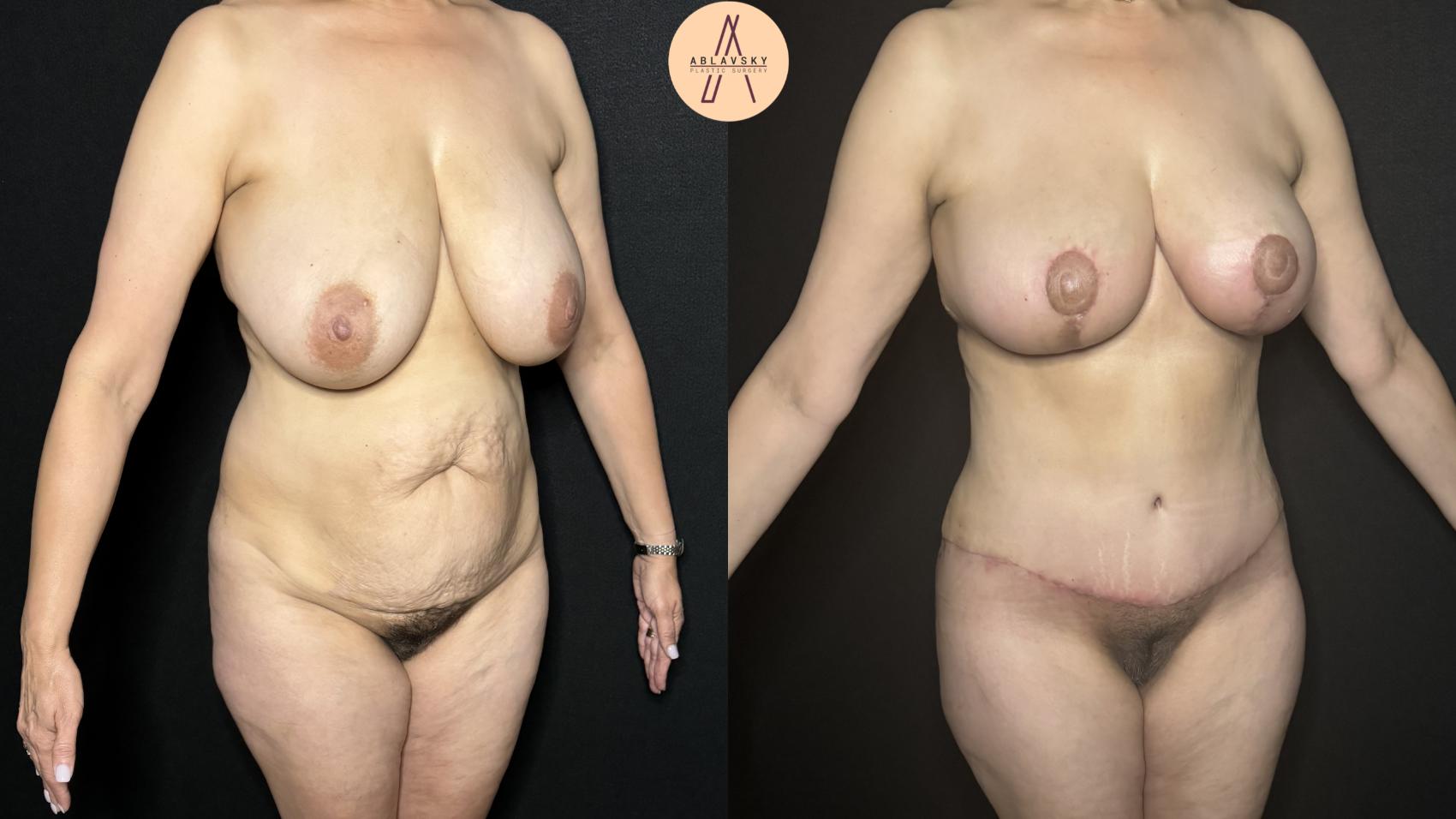 Before & After Tummy Tuck Case 288 Right Oblique View in San Antonio, Texas