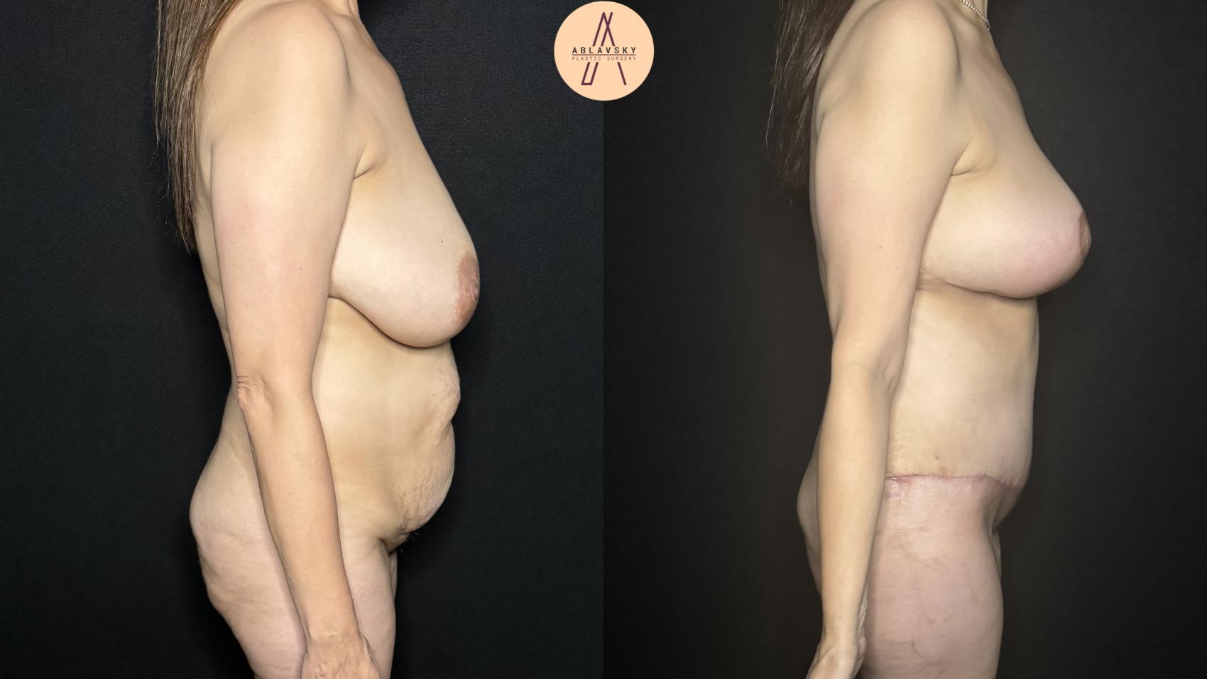 Before & After Tummy Tuck Case 288 Right Side View in San Antonio, Texas