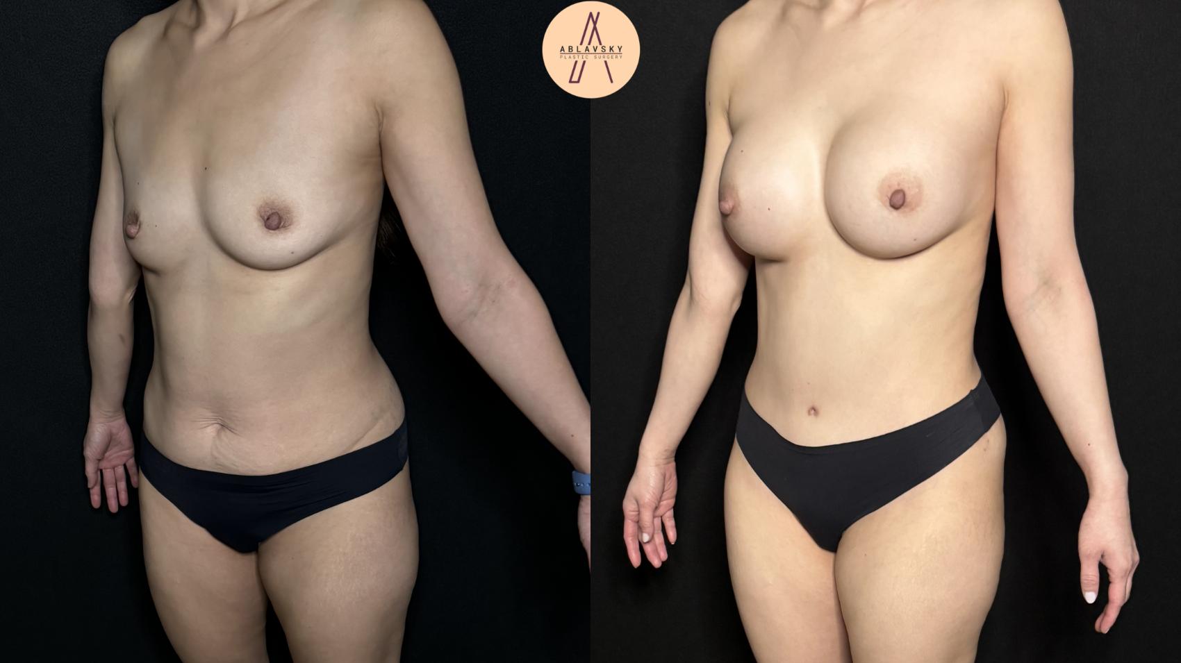 Before & After Mommy Makeover Case 290 Left Oblique View in San Antonio, Texas