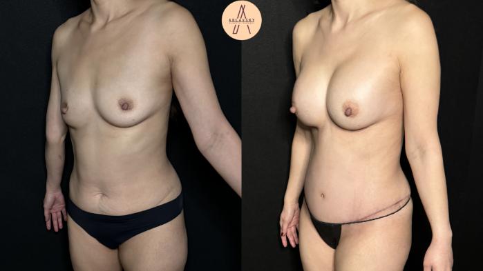 Before & After Mommy Makeover Case 290 Left Oblique View in San Antonio, Texas