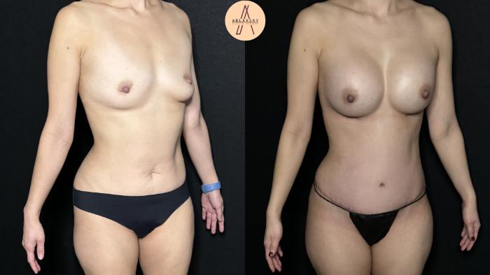 Before & After Mommy Makeover Case 290 Right Oblique View in San Antonio, Texas